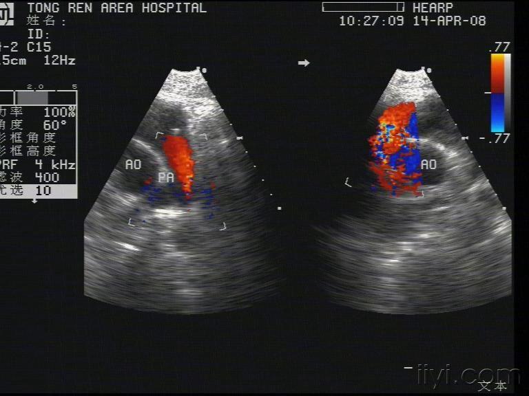 动脉导管未闭合并室缺 - 超声医学讨论版 - 爱爱医