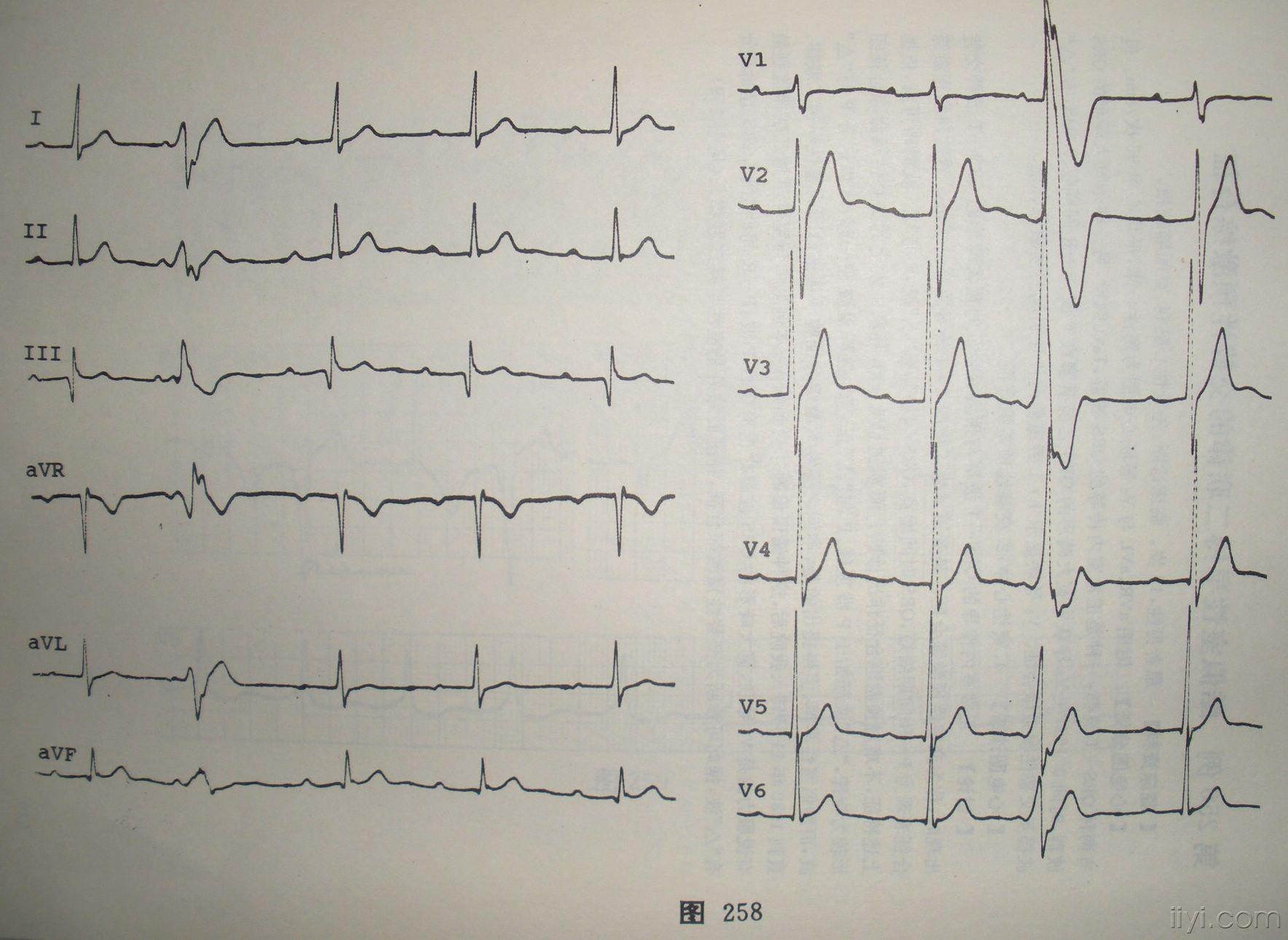 一份集室早预激于一体的心电图