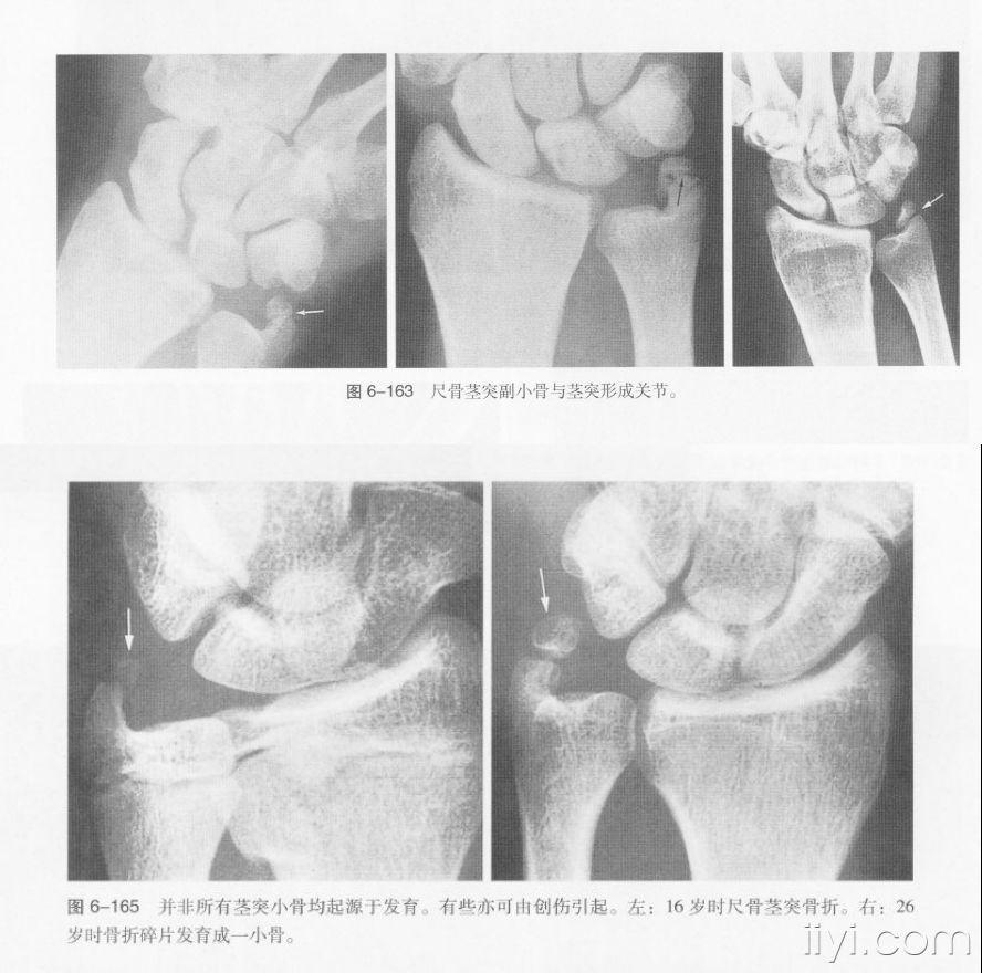 1,右桡远骨折,2,右尺骨茎突发育变异或陈旧性骨折?