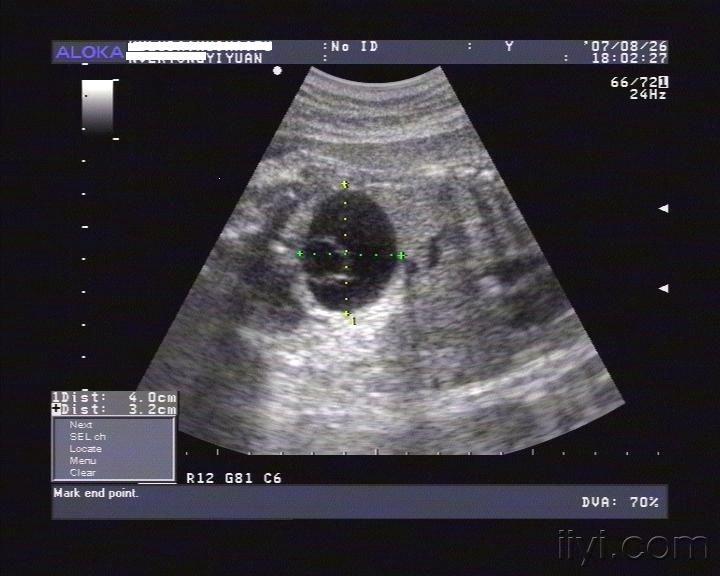 胎儿腹腔囊肿 超声医学讨论版 爱爱医医学论坛