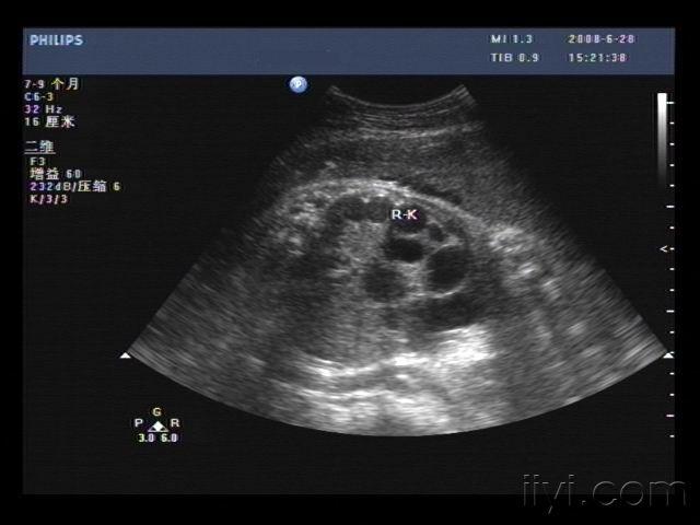 典型的胎儿多囊肾 超声医学讨论版 爱爱医医学论坛