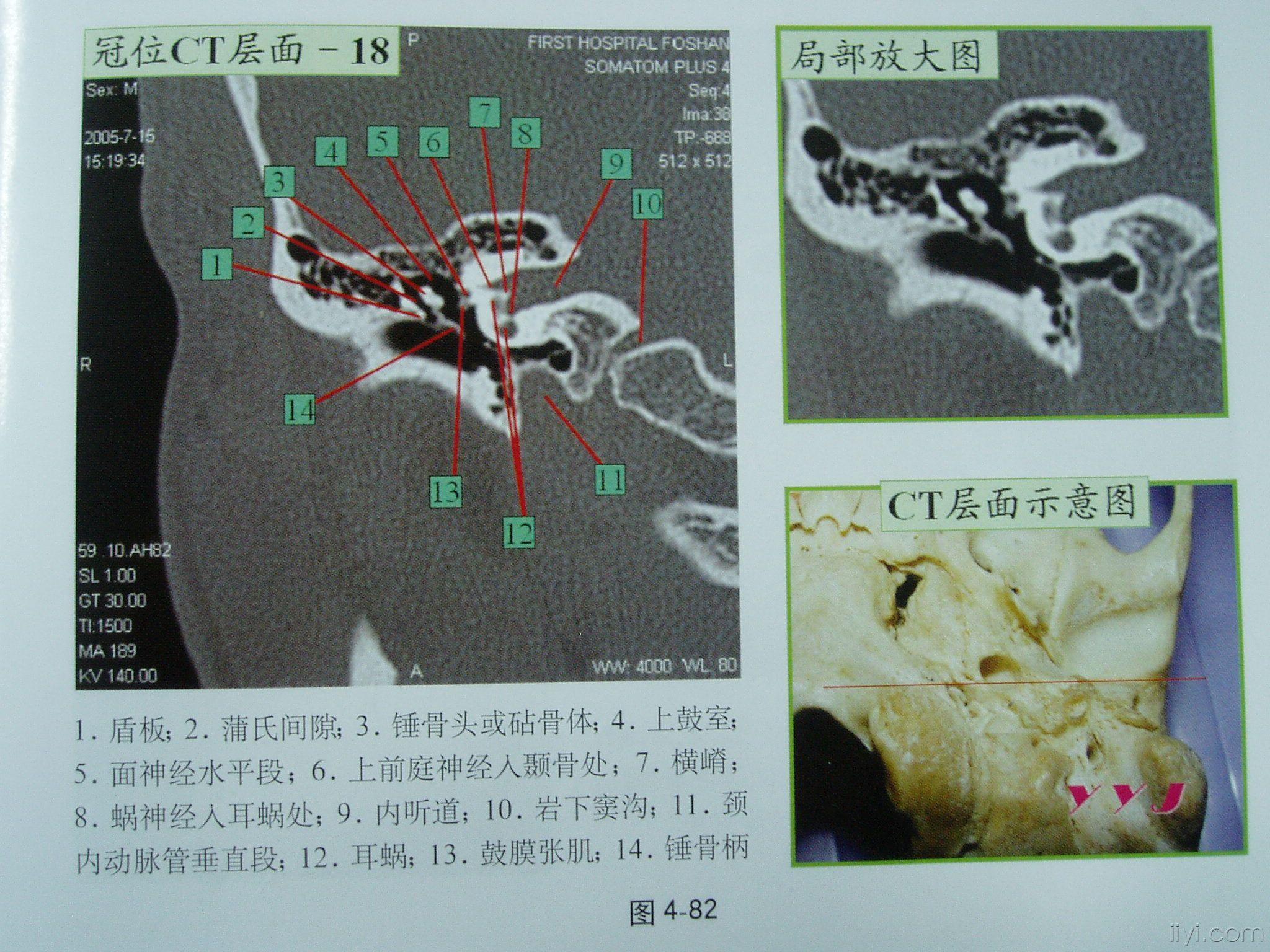 耳部正常ct(冠位 轴位)