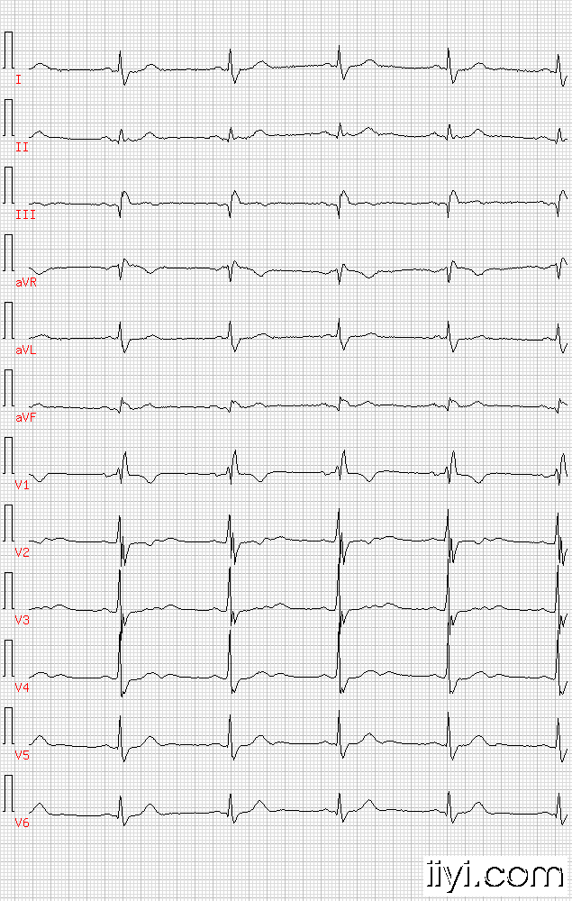 窦性心动过缓,右束支传导阻滞,下部梗死.gif