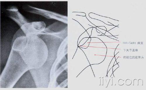 肩关节前脱位1.jpg