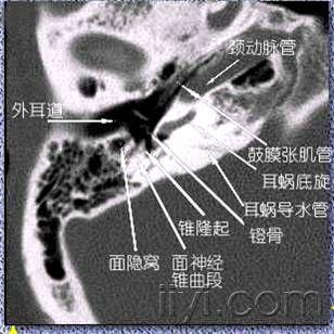 请教颞骨解剖鼓窦乳突窦吗鼓窦入口窦入口图文并茂更好谢谢