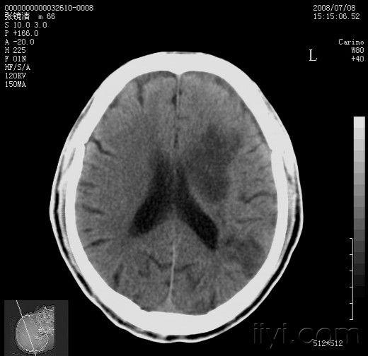 左侧基底节区梗塞后出血?