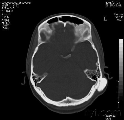 左颞骨外生骨疣