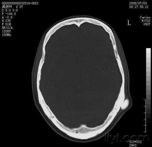 左颞骨外生骨疣