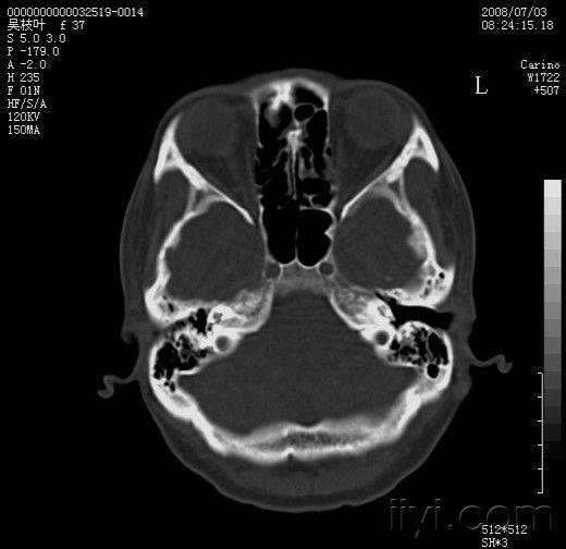 左颞骨外生骨疣