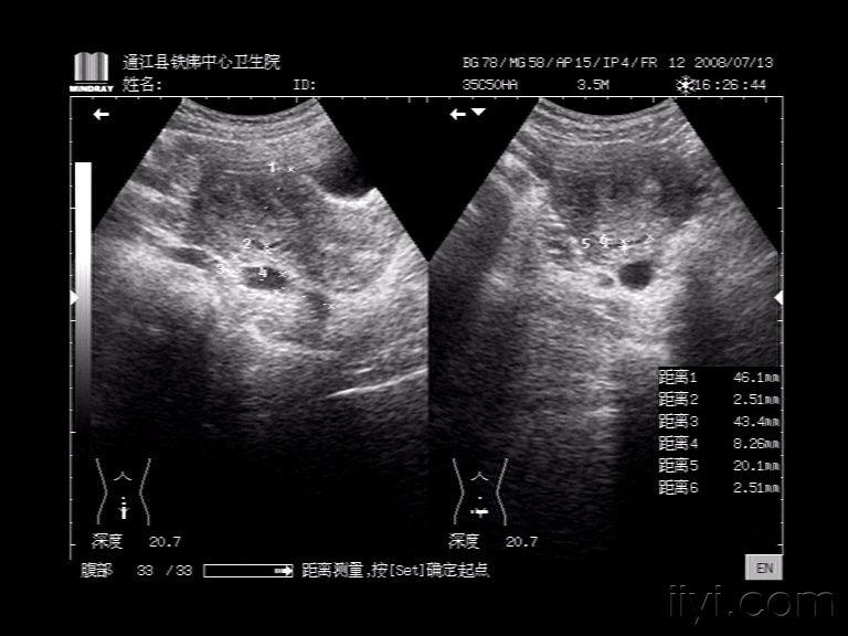 子宫肌层暗带回声超声诊断该如何下