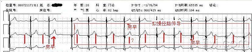 结内双径路传导