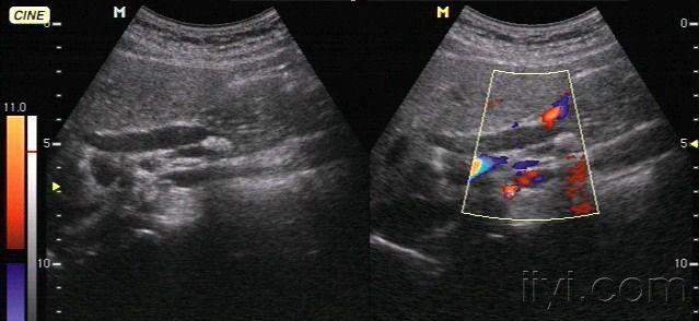 常见病-胆总管结石 - 超声医学讨论版 - 爱爱医医学