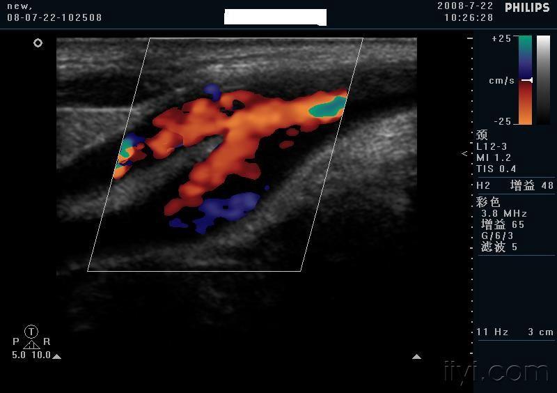 漂亮的颈总动脉分叉 - 超声医学讨论版 - 爱爱医医学