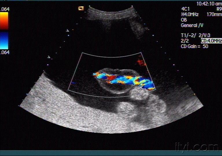 胎儿脐带水肿声像图
