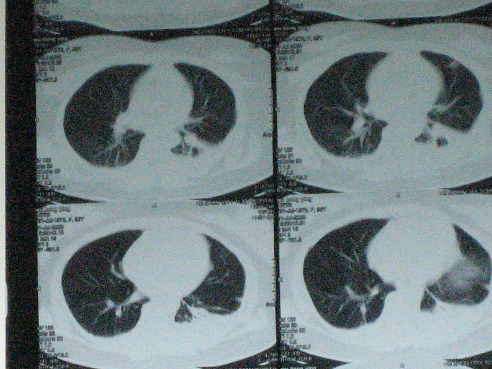 求助:左下肺不张患者下一步治疗