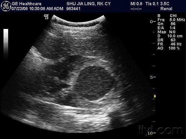 肾囊肿伴感染 - 超声医学讨论版 - 爱爱医医学论坛