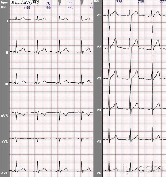 69 心电图脑电图专业讨论版 69 交界心律胸导联p波特征能倒置吗?