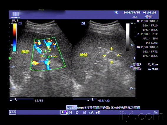 副脾- 超声医学讨论版 - 爱爱医医学论坛