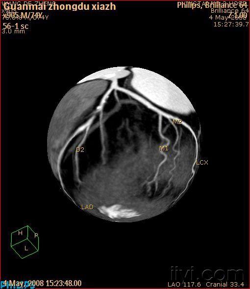 冠脉cta,冠脉重度狭窄欣赏