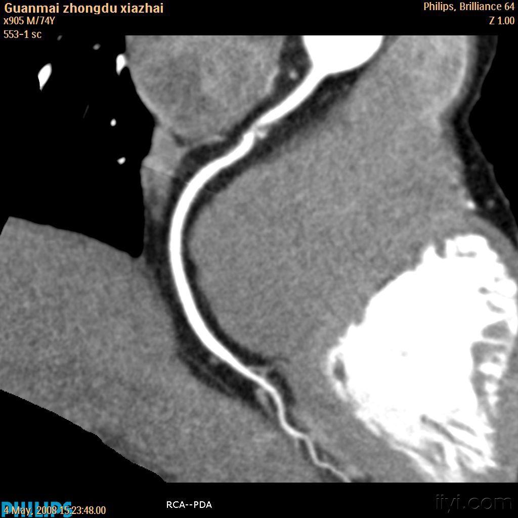 冠脉cta,冠脉重度狭窄欣赏