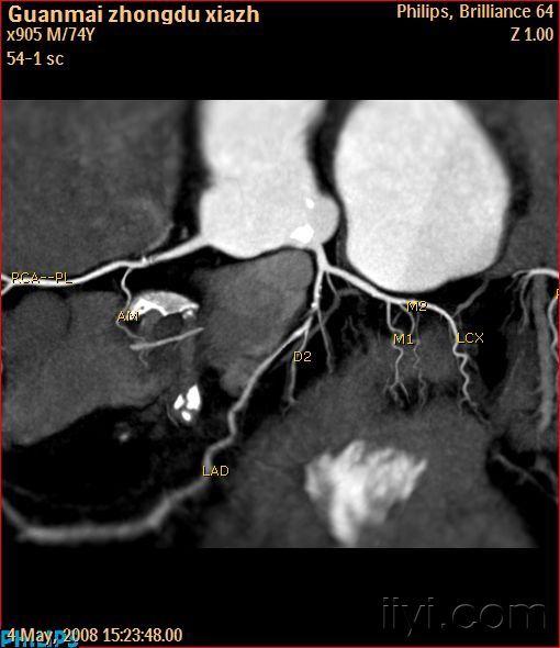 冠脉cta,冠脉重度狭窄欣赏