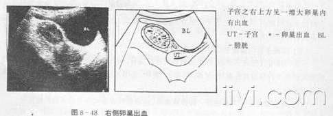 右侧附件区囊实性占位考虑什么