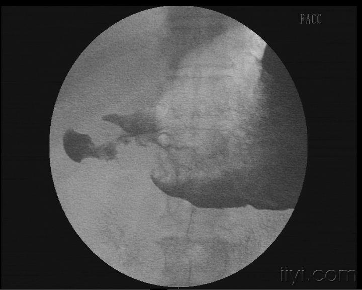 交流上消化道钡餐透视