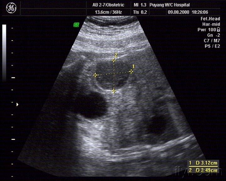 【讨论】胎儿右侧腹部探及不均质低回声包块,你看是?