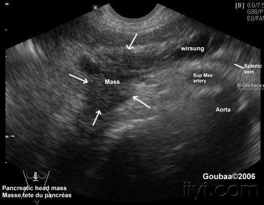 胰腺癌(pancreatic carcinoma) - 超声医学讨论版