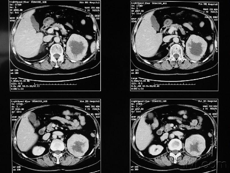 肾ct病例(病理结果)