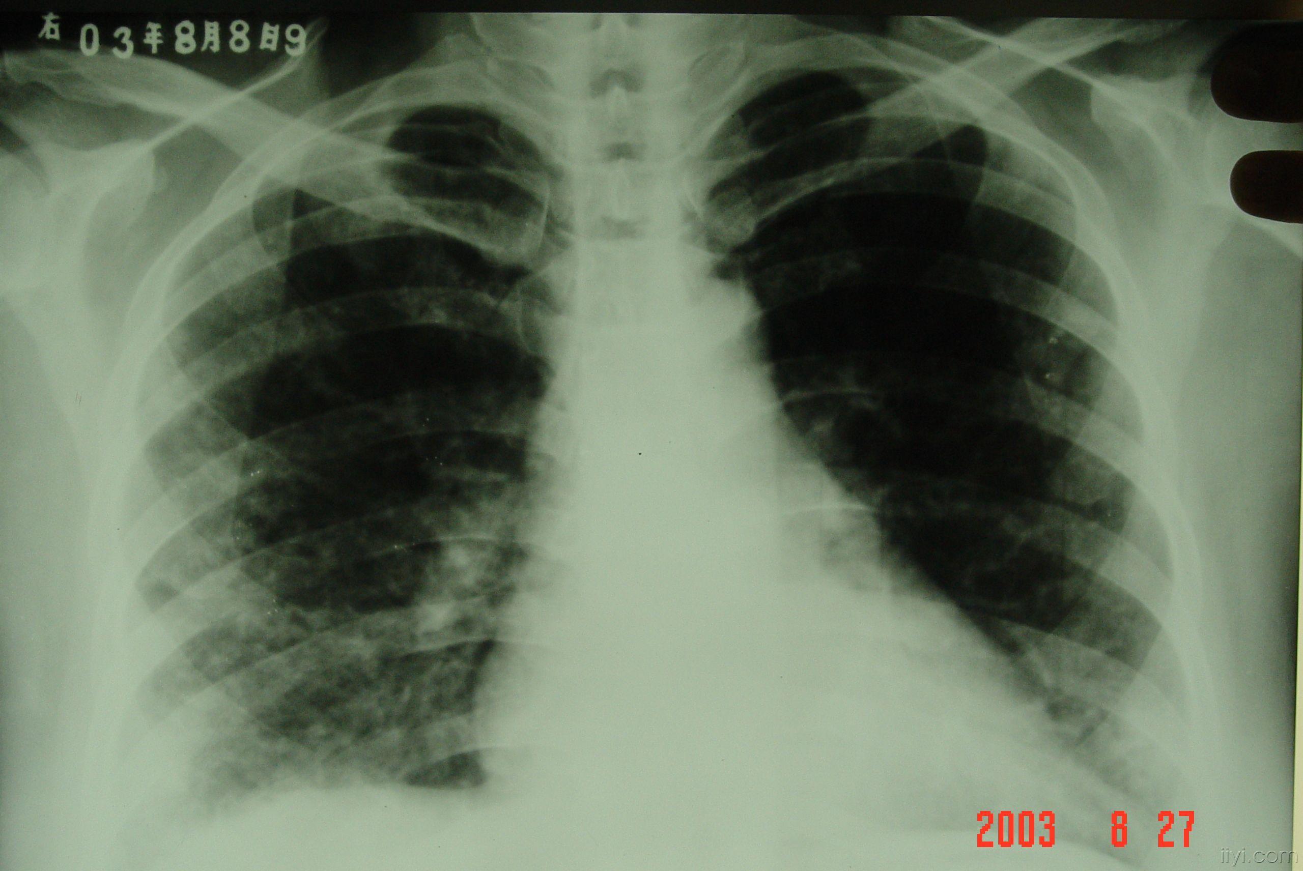 肺结核 医学影像学讨论版 爱爱医医学论坛