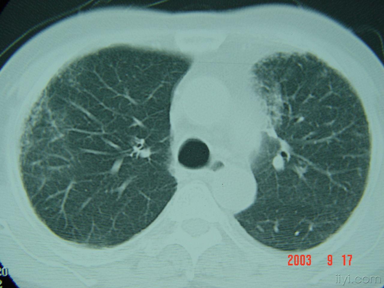 肺间质纤维化 - 医学影像学讨论版 - 爱爱医医学论坛