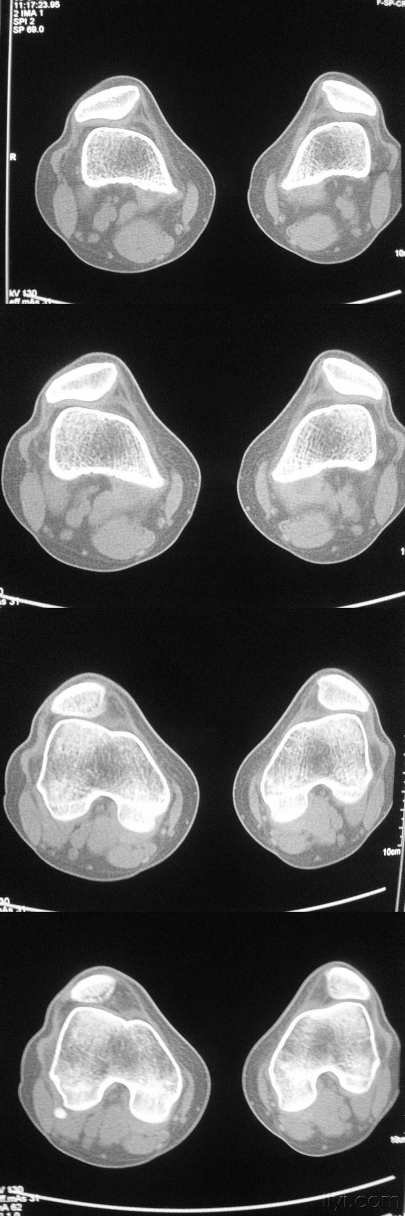 膝关节检查一个有特征性病理意义的ct征像(学习体会已