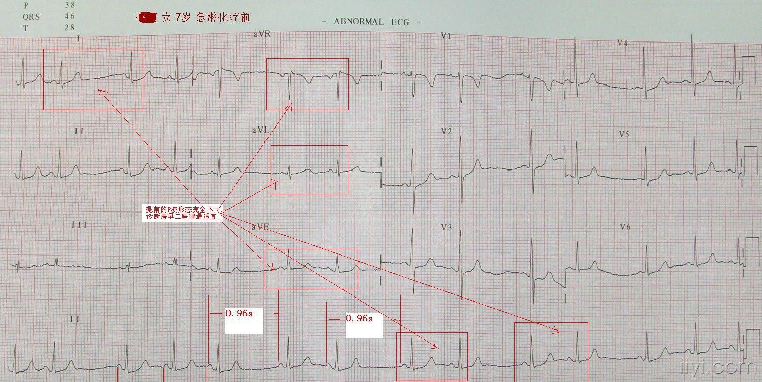 这份图前后的是不一样的,第一份图可以明确是频发房早,部分呈二联律