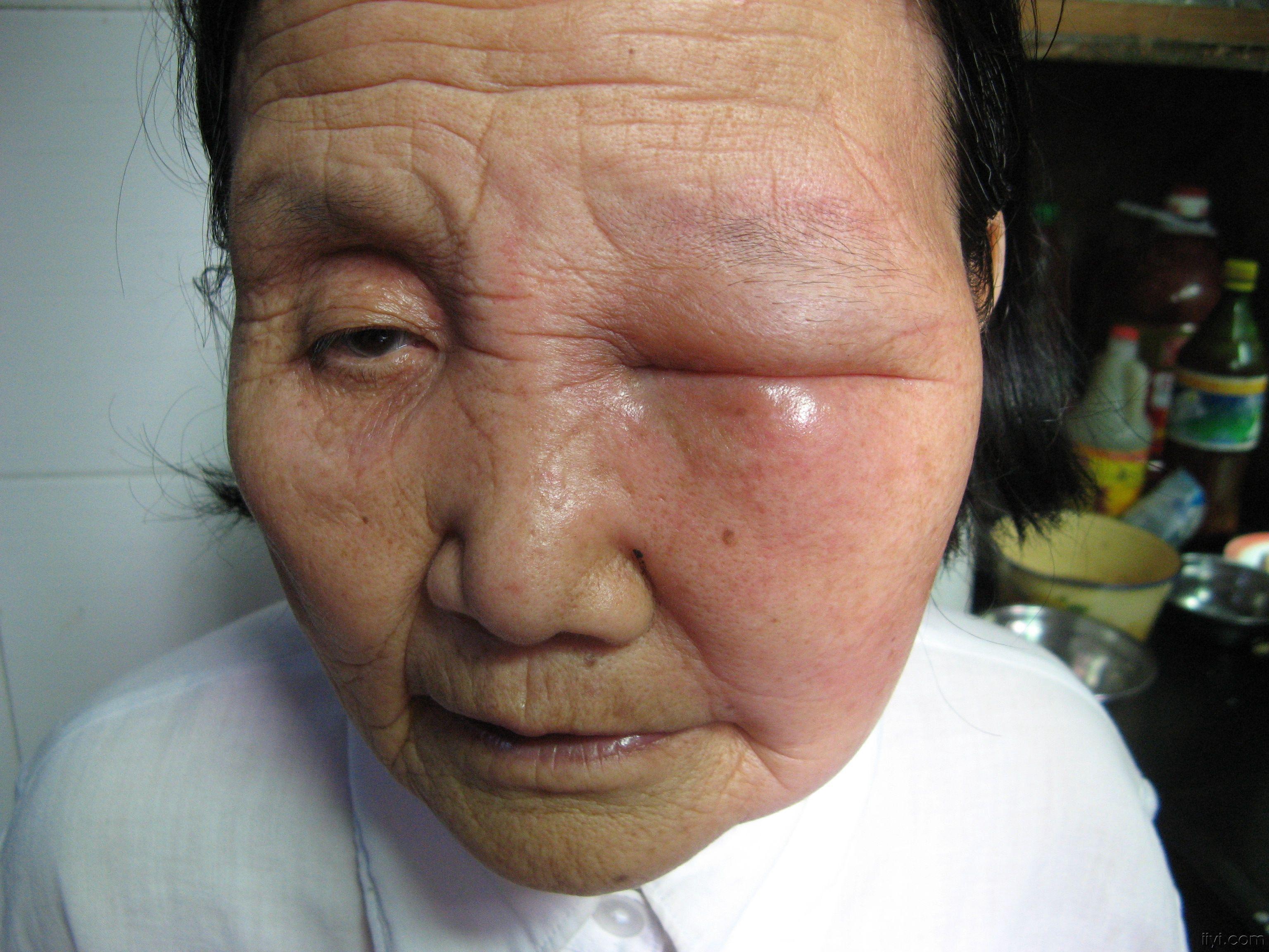 一例老年患者被毒蜘蛛咬伤的治疗附图