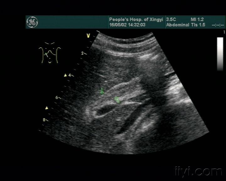 胆道蛔虫 - 超声医学讨论版 - 爱爱医医学论坛