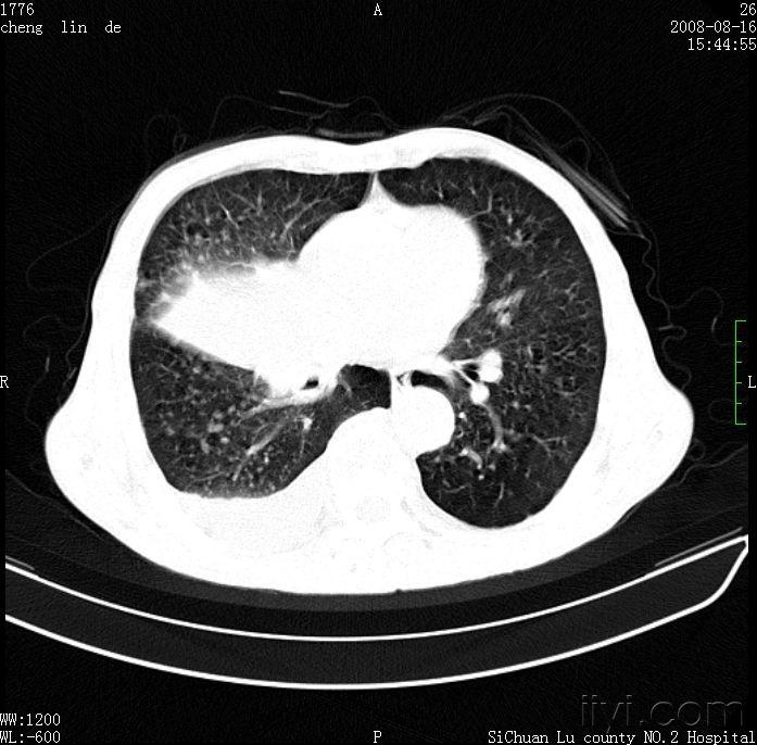 右肺中央型肺癌,左肺上叶矽肺结节?