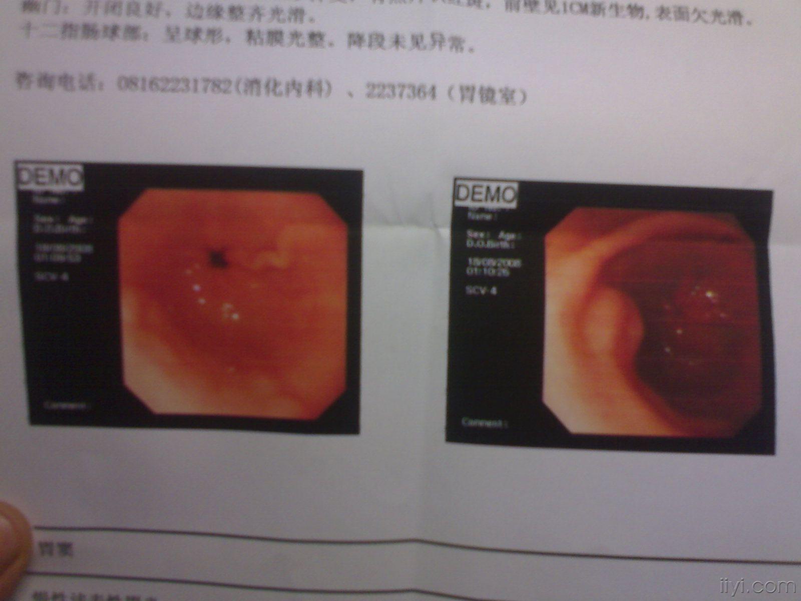 今天我的老妈做了一个胃镜提示可能是胃窦间皮瘤,我想请问这个是良性