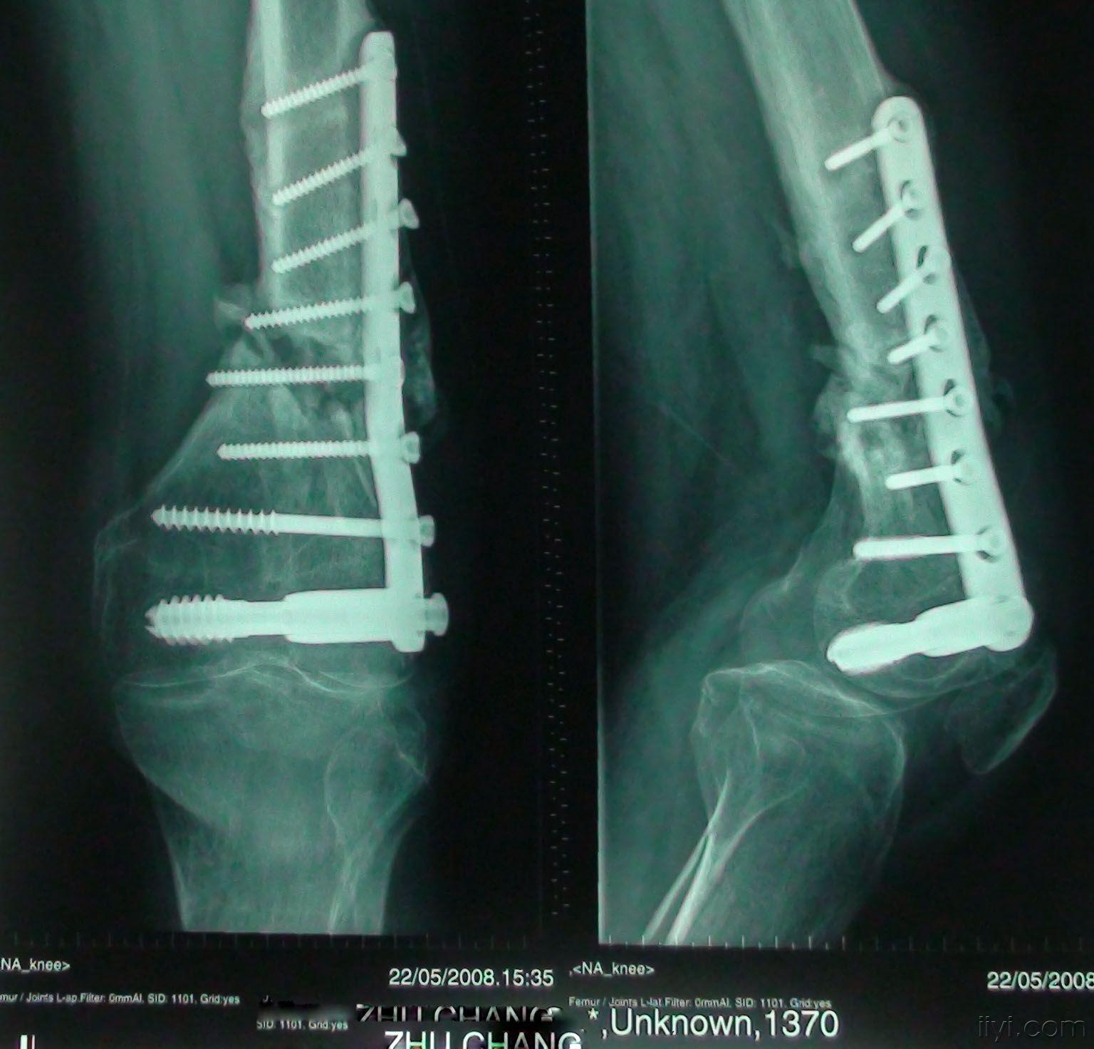 大家来看看罕见股骨髁上骨折dcs固定术后骨不连二次手术说的有道理送