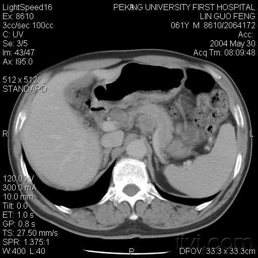 【病理】胃ct 讨论
