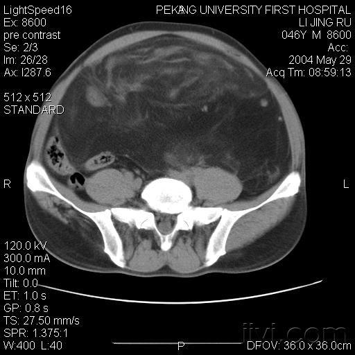 【病理】腹部ct病例讨论