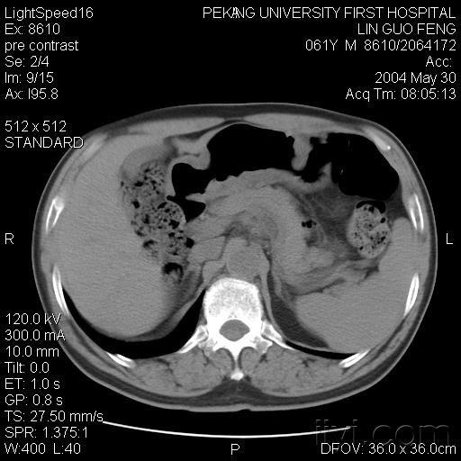 【病理】胃ct 讨论