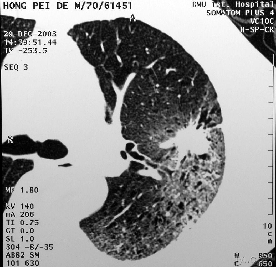 【病理】肺ct 病例讨论