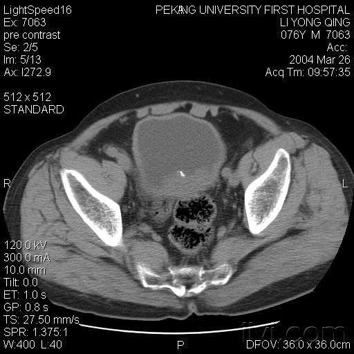 病理膀胱ct讨论病例2