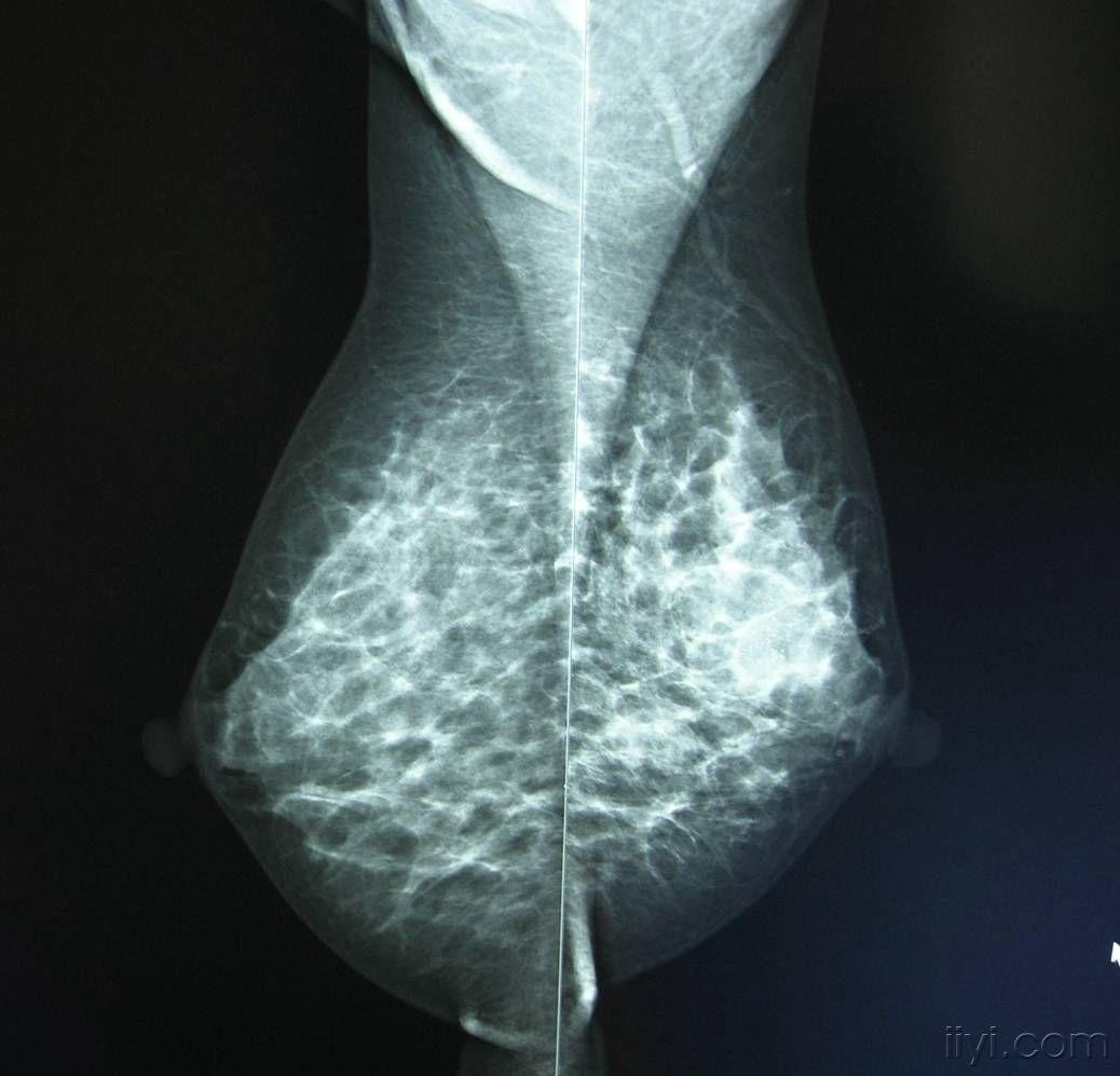 典型乳腺癌钼靶片(附有病理)