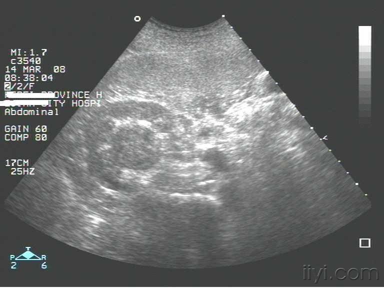 肾脏横切图像