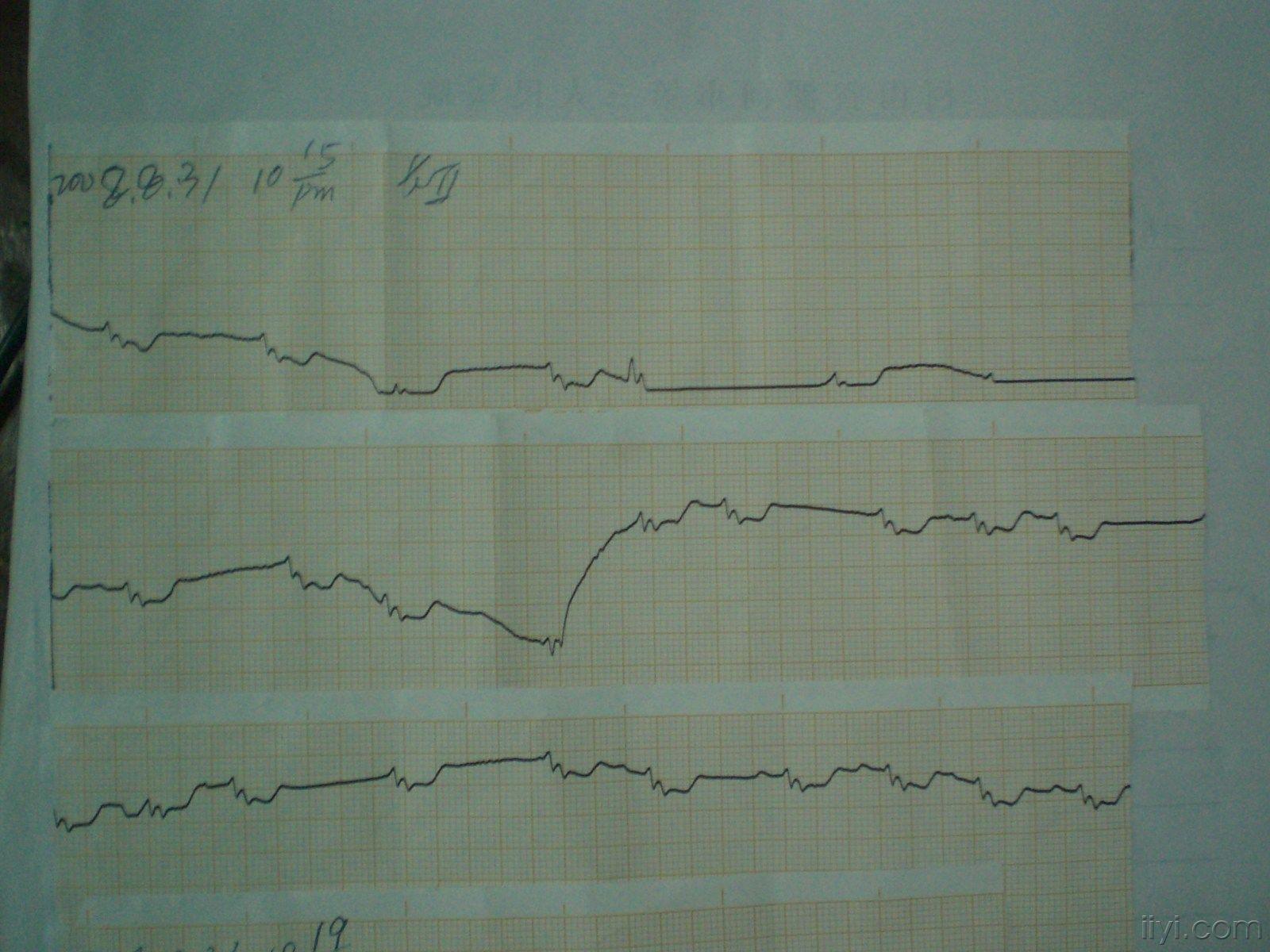 这是后来的心电图.之后没多久心脏骤停死亡.请大家看看是不是电交替?