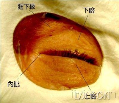 疤痕  而且  结扎术  内窥镜  选择性