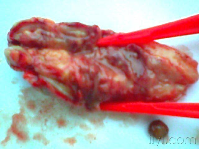 分享经典病例化脓性阑尾炎穿孔伴腔内粪石超声图片及术后标本比对