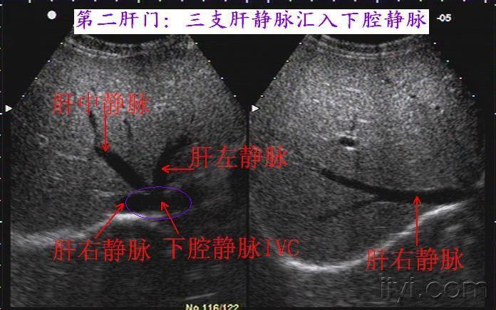 5a 第二肝门结构.jpg